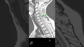 MRI - CERVICAL SPINE ARTEFACT