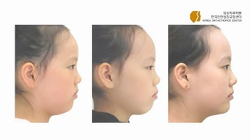 case no. 4: Class III open bite