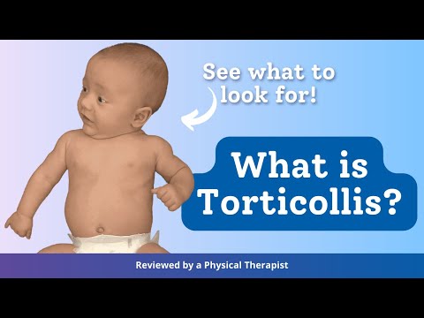 What is Torticollis?