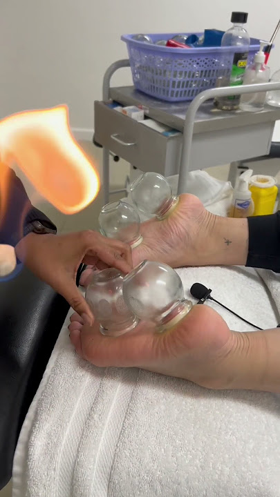 🔥FIRE CUPPING🔥 ON THE FEET! #asmr #sydney #chiropractic #massage #shorts