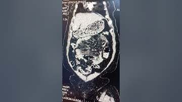 Xoắn ruôt CT, mạch mạc treo dấu hiệu "xoáy nước"