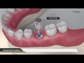 Procedimento Cirúrgico 3D - Arcsys Sistema de Implantes | FGM