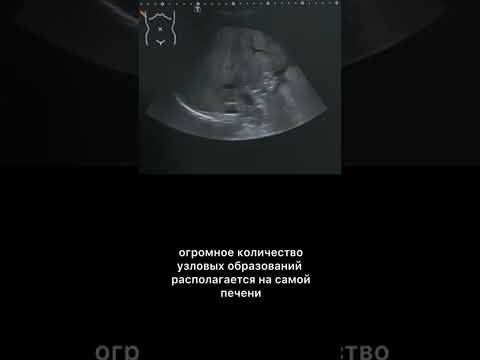 #узи #асцит #цирроз