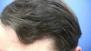 Dr Hasson Hair Transplant - 4744 Grafts -  1 Surgery Session