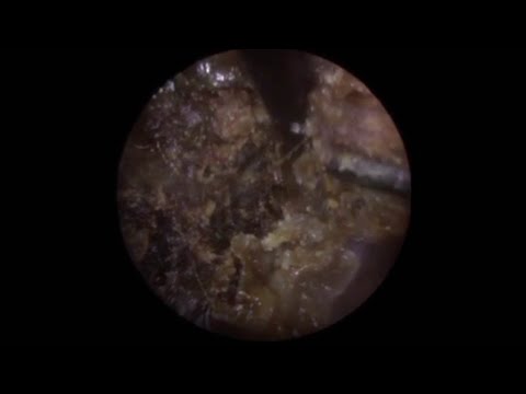 16 Years Worth Of Ear Wax Removed From Patient