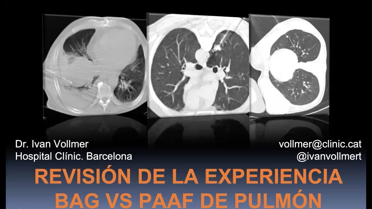 Paaf Revisión de la experiencia en PAAF versus BAG de Pulmón. - YouTube