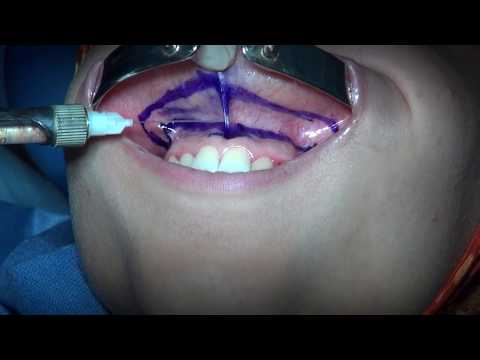 surgical lip re positioning  for correction of gummy smile - YouTube