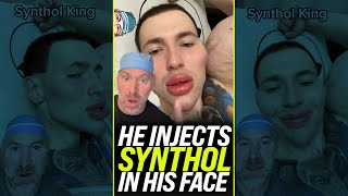 Injecting Synthol Into Your Face? 