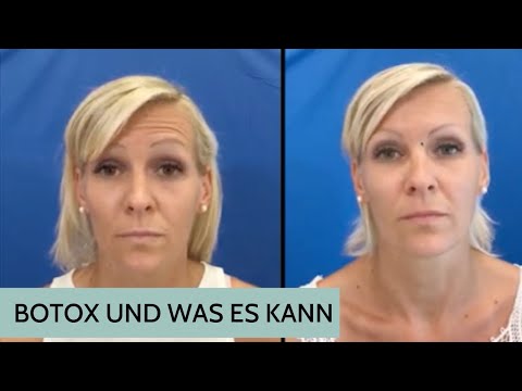 Video: Was Ist Botox?