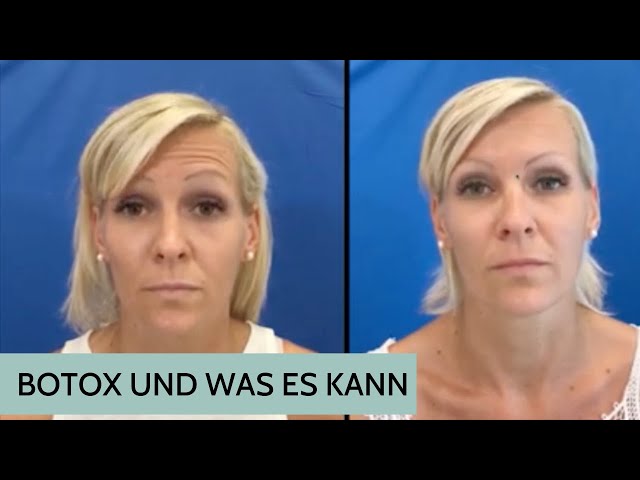 WAS ist BOTOX? Was kann es?  I DR. ROLF BARTSCH