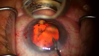 Omni goniotomy with Glaukos iDose