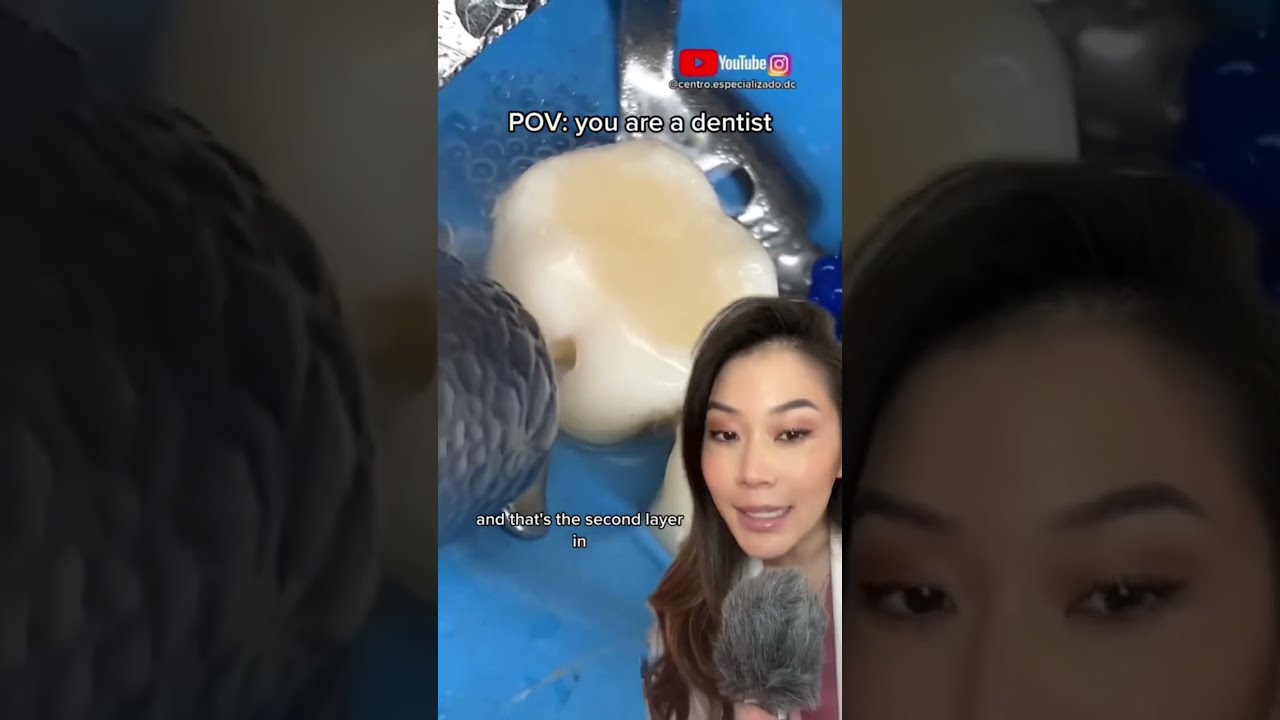 POV Filling A Small Cavity Dentist Smallcavity Drilling Dentistry Dentalvideo