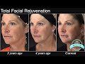 60 yo Female Facial Rejuvenation - A Refreshed Face | Aesthetic Minutes #Facelift #Blepharoplasty