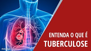 Entenda o que é Tuberculose