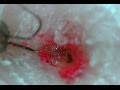 Ingrown Hair 埋没毛の救出！PART15（若干出血注意）