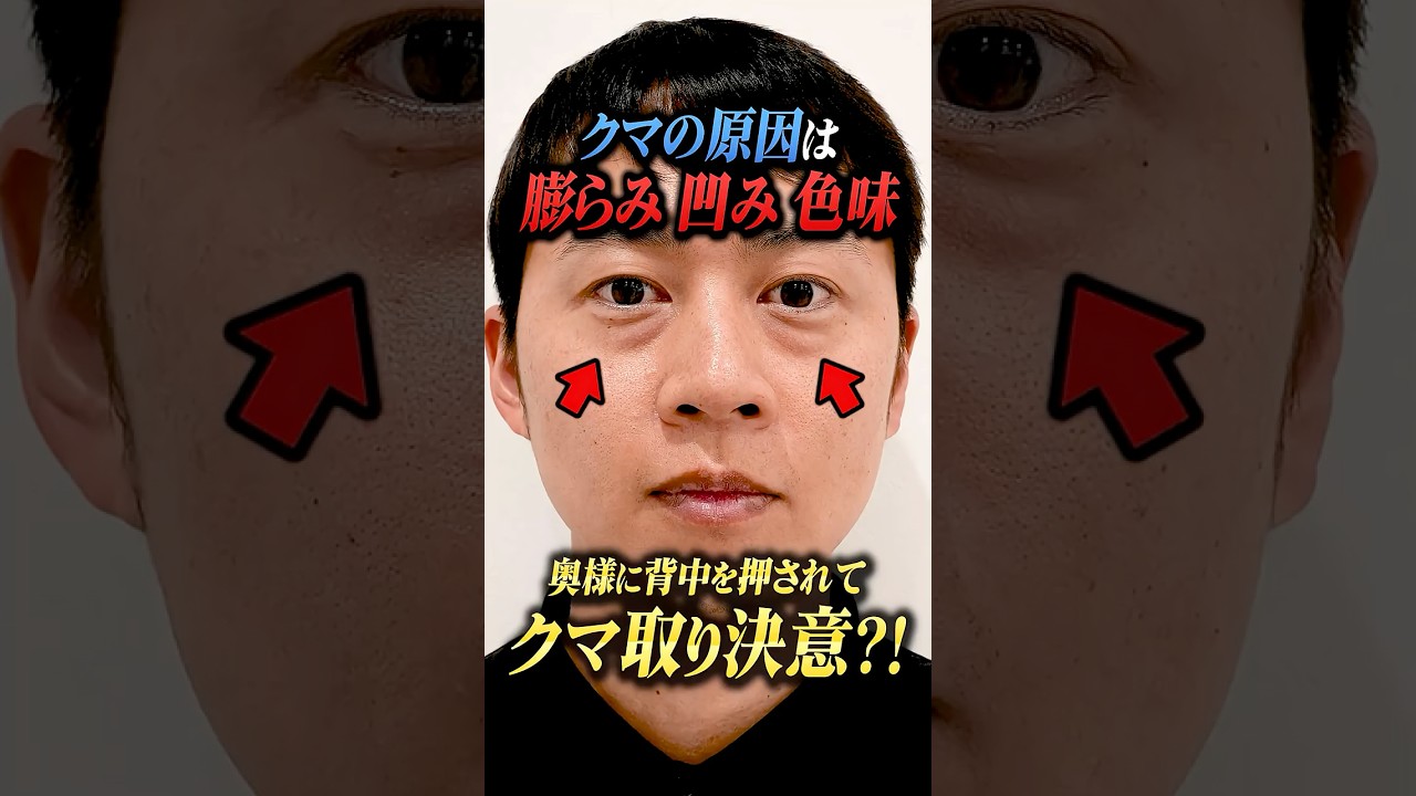 【メンズクマ取り】男が整形ってどう?怖くて何年も悩んだ39歳のリアル#クマ取り #クマ取整形 #目の下のクマ #クマ診断 #クマ取りナビ #裏ハムラ #脂肪注入#美容整形#湘南美容クリニック