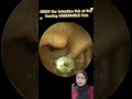 CRAZY Ear Infection Full of Pus Causing UNBEARABLE Pain