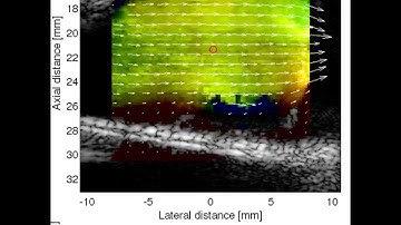 Ultrafast blood flow measurement of a jugular vein with valve.