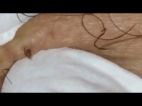 Blackheads Removing Satisfying And Largest Ingrown Hair Removal