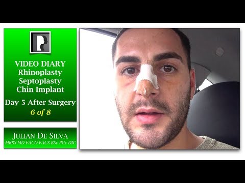 6. Male Rhinoplasty,