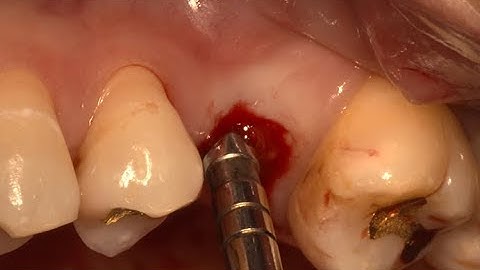 Simple sinus augmentation with Osteotome technique