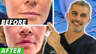 Entire Lip lift Procedure from Start to Finish (beautiful after result)