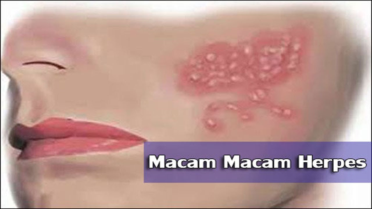 nama obat herpes simplex, obat herpes simplex 1, obat herpes simplex 2, oba...