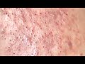 ВНИМАНИЕ!   Выдавливание чёрных точек
