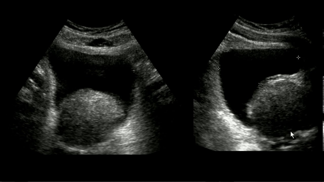 leche de próstata transrectal