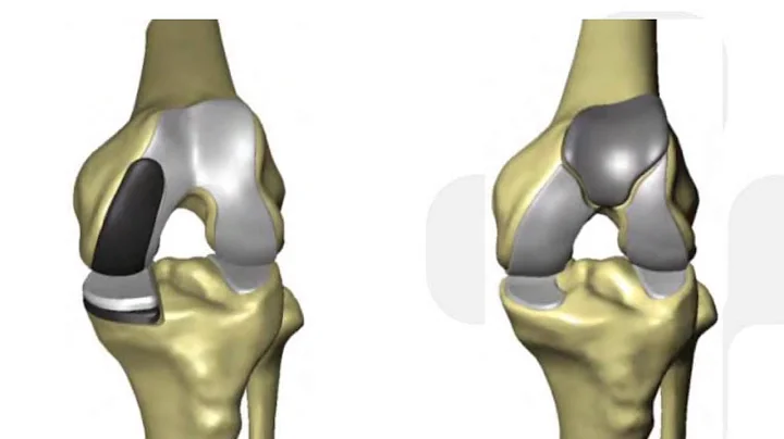 Outcomes & Benefits of Robotic Joint Replacement S...