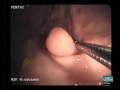Intussusception of the appendix