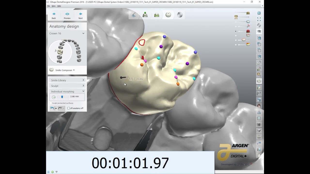Fast 3 Minute Crown Design with 3Shape - YouTube
