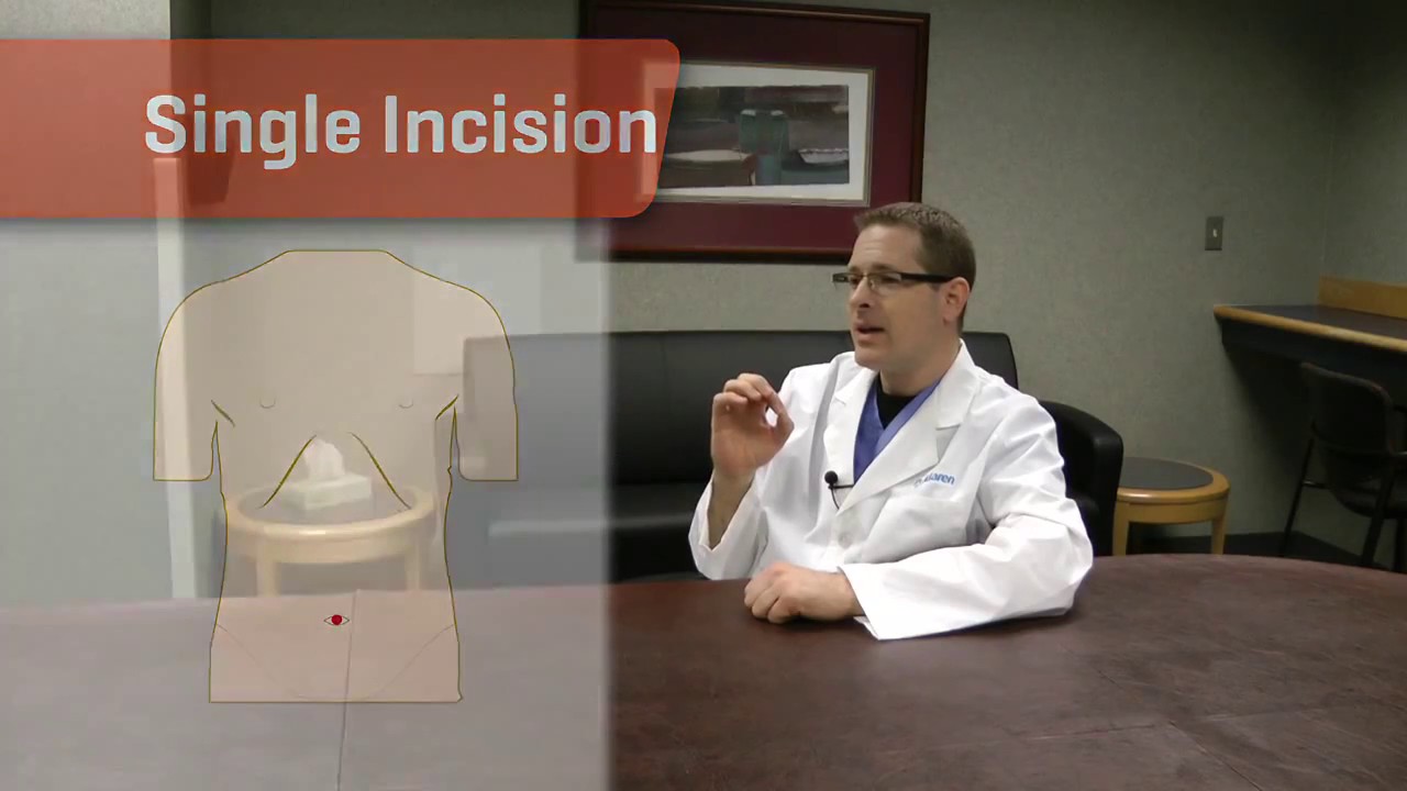 Single-Site da Vinci Gallbladder Surgery - McLaren Macomb Robotic Surgery video thumbnail