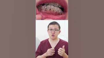 Bị tam giác đen có phải do cạo vôi răng #bsck1buihonghiep #niengrang #dentist #orthodontist