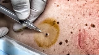 Blackhead Removal with Dr. Gilmores 🤩👍🤩