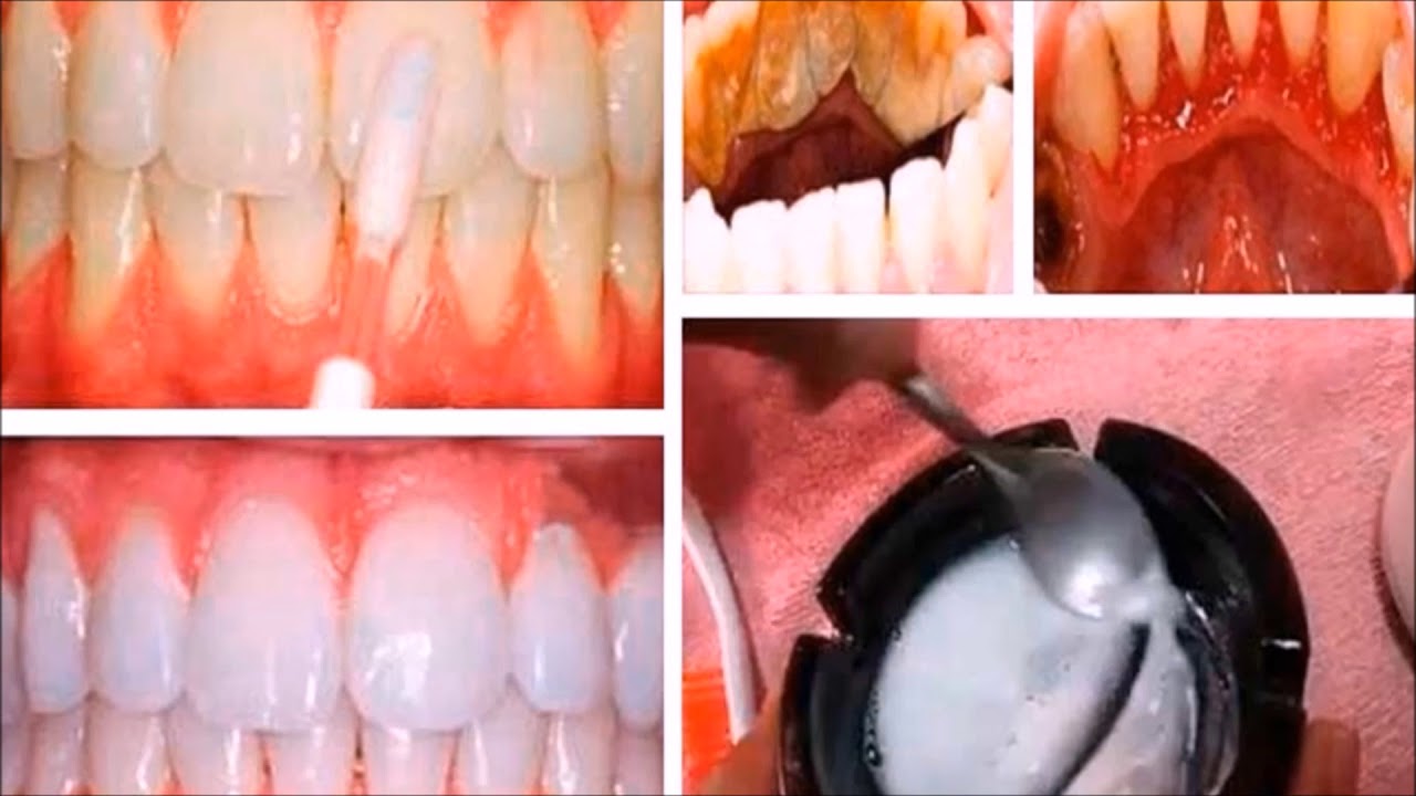 Elimina El Sarro Y Blanquea Tus Dientes En tan solo 15 Minutos remedios naturales para la artritis