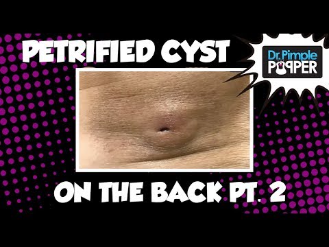 A Truly Petrified Cyst: Part 2!