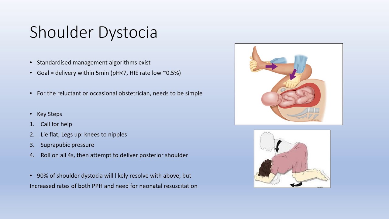 Shoulder Dystocia YouTube