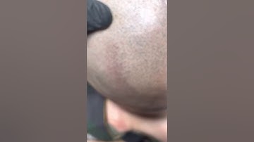 When Scalp Micropigmentation goes wrong and how to fix it!