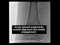 The TAME Lab: How to Handle Acute Angle Vessels