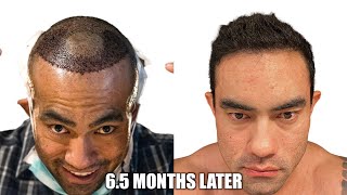 My 6 Month Hair Transplant Update