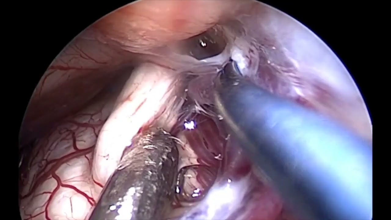 Endoscopic Vascular Decompression of Trigeminal Neuralgia