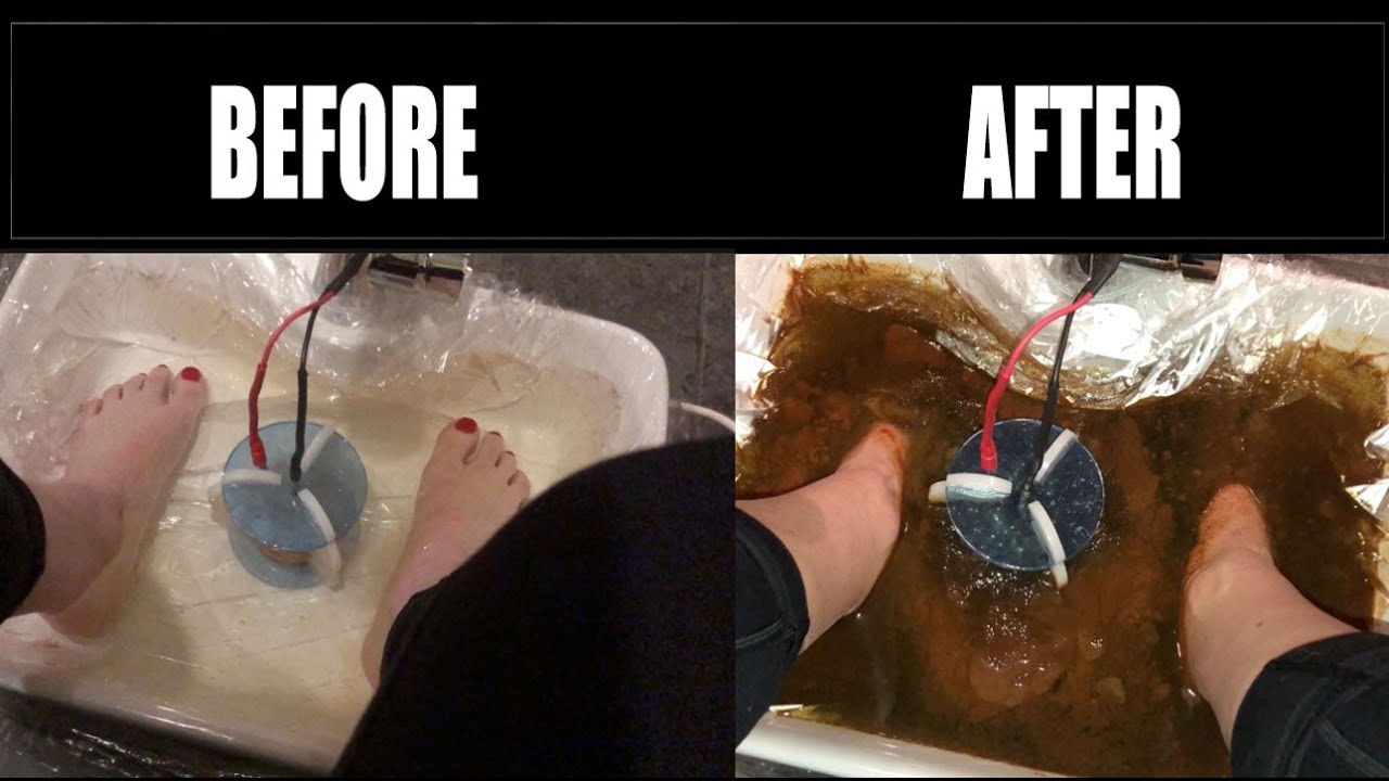 EPISODE 4 HEALING CHRONIC ILLNESS Foot Detox YouTube