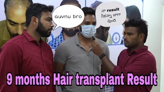 Hair Transplant 9 Months Results || Telugu Hair Transplant || interview with hair transplant person