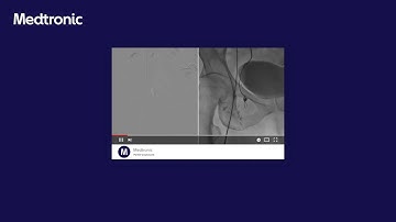 Right ovarian vein embolization