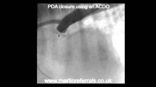 PDA closure in a dog using an ACDO