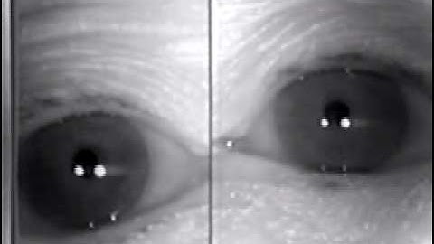 Abnormal Cranial Nerve Exam : Vergence