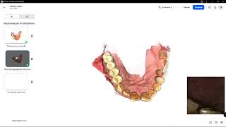 Primescan2 On Implants