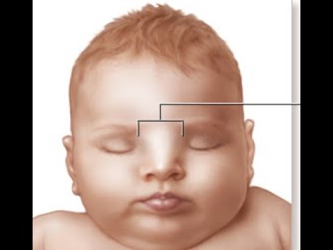 Potter Sequence Causes, Signs and Symptoms, Pathogenesis: What is Potter&rsquo;s Syndrome?