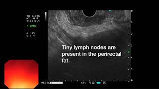 EUS for T3N1 Rectal Cancer